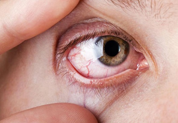 眼乾症導致眼睛紅腫
