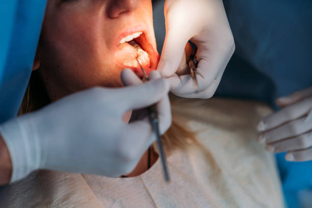 去除牙菌斑和牙結石可以預防牙周炎
