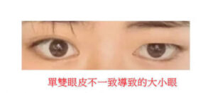 大小眼原因