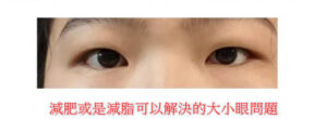 大小眼原因