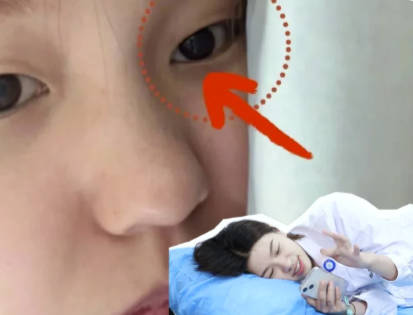 大小眼改善方法